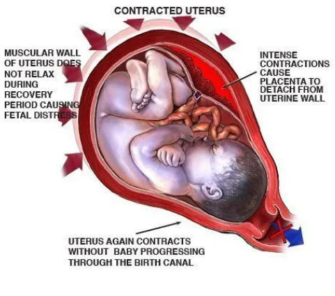 The Risks of Using Cytotec as a Labor-Inducing Agent