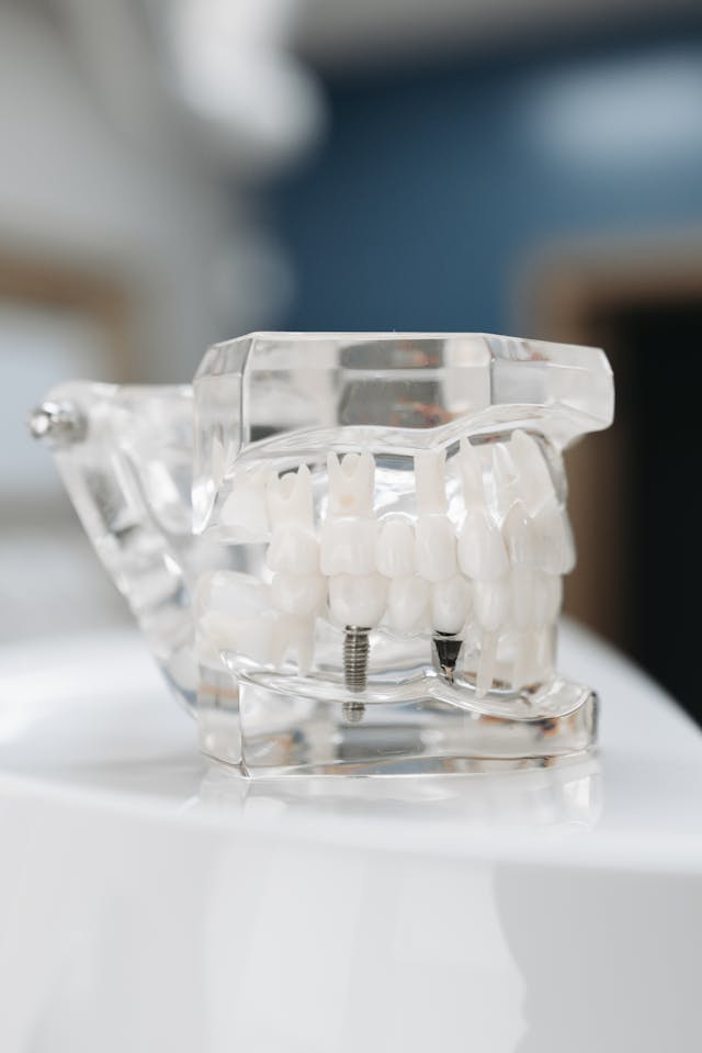 Dental Implants